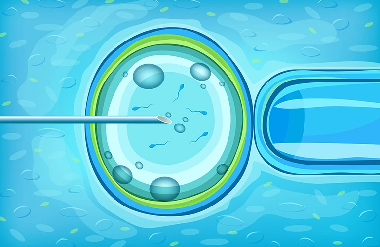 Intra Cytoplasmic Sperm Injection (ICSI) n Dubai